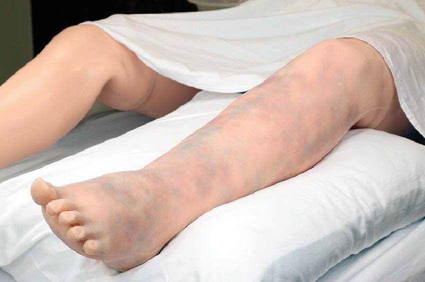 Обострение венозных проблем летом и подготовка к жаре