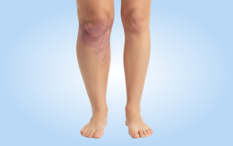 Стадии венозной недостаточности и лечение от отёков до язв